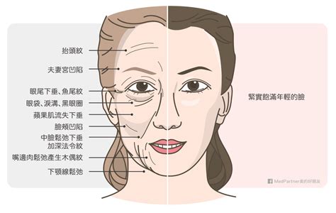 法令紋過嘴|法令紋太深好顯老！醫師告訴你4大法令紋分類、成因。